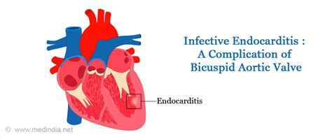 Bicuspid Aortic Valve Causes Symptoms Complications Diagnosis