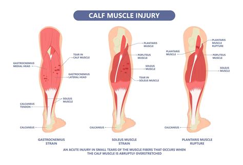 calf muscle pain   calf muscle pain sore calf muscle