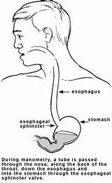 Manometry Hiccups Esophageal Reflux Acid Esophagus Tests Identify sketch template