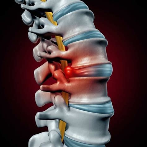 herniated disk  symptoms exercises surgery treatment