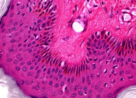 squamous cell papilloma   magnification nikons microscopyu