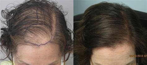 womens hair transplant   pictures dr sean behnam