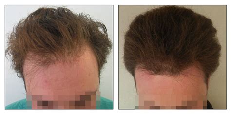 fue hair transplant  sessions  grafts hair transplant hair clinic fue hair transplant