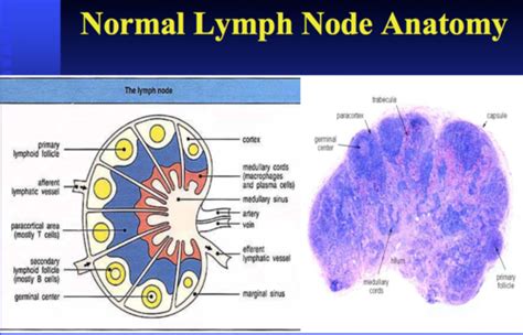 Pathology Of Lymph Nodes And Lymphomas Flashcards Quizlet