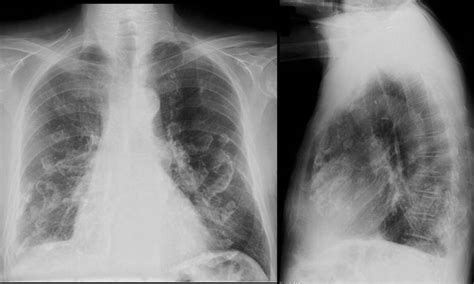Asbestos Related Pleural Plaques Images Diagnosis Treatment Options