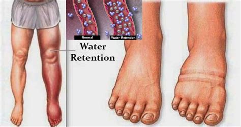 Water Retention Causes And How To Avoid It Valentin Bosioc