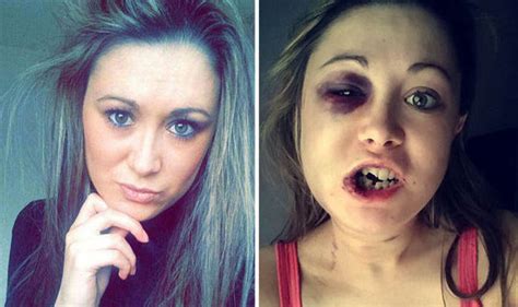 Graphic Content Horrific Pictures Show Man Beat Girlfriend