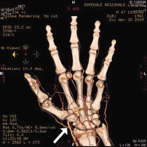 digital artery aneurysm hand orthobullets
