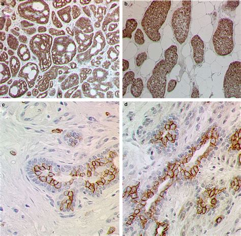 pathology outlines adenoid cystic carcinoma