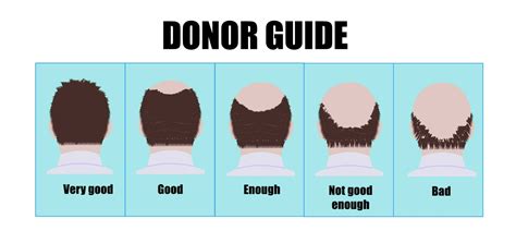 donor area  hair transplantation dr  esthetic