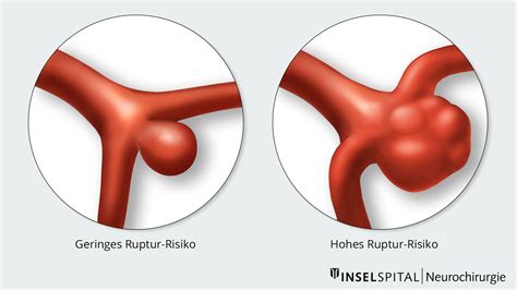 aneurysma einer hirnarterie neurochirurgie inselspital bern