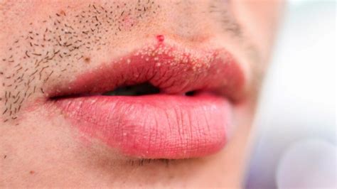 Bumps On Lips Small Little White Or Red Causes