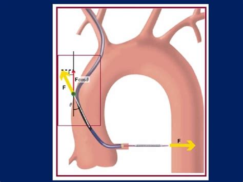 percutaneous coronary interventions basic principles   procedure