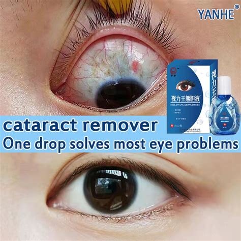 15ml Original Eye Drops For Cataract Eyedrops For Tired Eyes Dry Sore