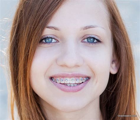 redhead girls with braces porn images