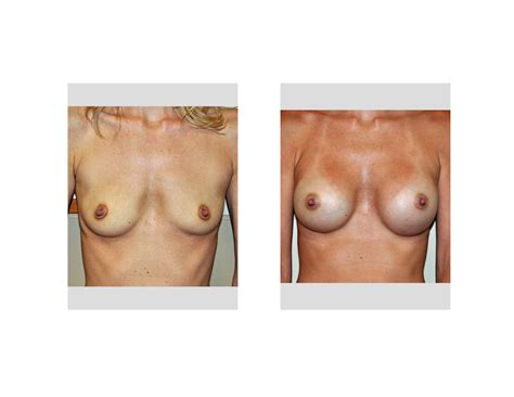 natural breast enlargement enhancement porno photo