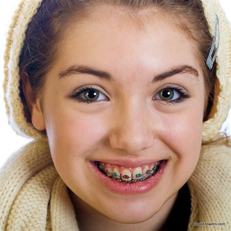 60 photos of teenagers with braces oral answers