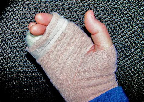 broken hand doctors campbell clinic