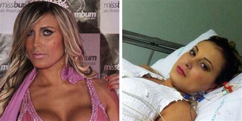 Miss Bumbum Model Andressa Urach Reveals Horrific