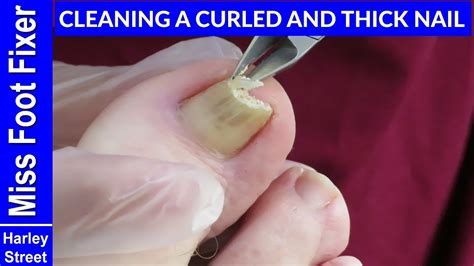 Cutting And Cleaning Of Very Hard And Thick Toenail By Miss Foot Fixer