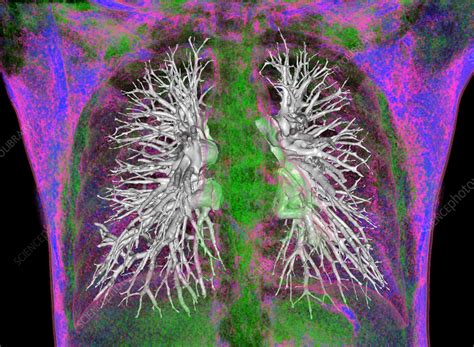 Healthy Lungs Ct Scan Stock Image C057 3442 Science Photo Library