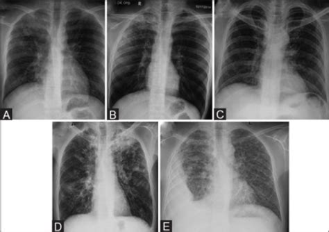 Chest Radiographs In Active Tb A Cxr Depicts Rt Uppe Open I