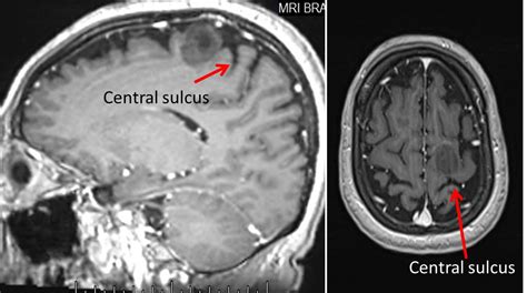 central sulcus radiology cases