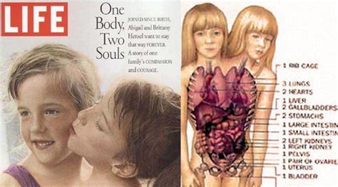 Everything To Know About Famous Conjoined Twins Abby And