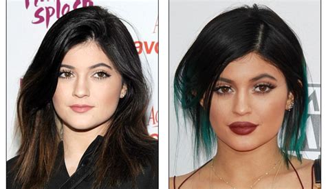 Utah Facial Plastic Surgeon Weighs In On Kylie Jenner S Lips
