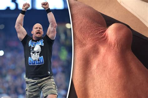 Stone Cold Steve Austin Freaks Fans With Bizarre Elbow Injury Daily Star