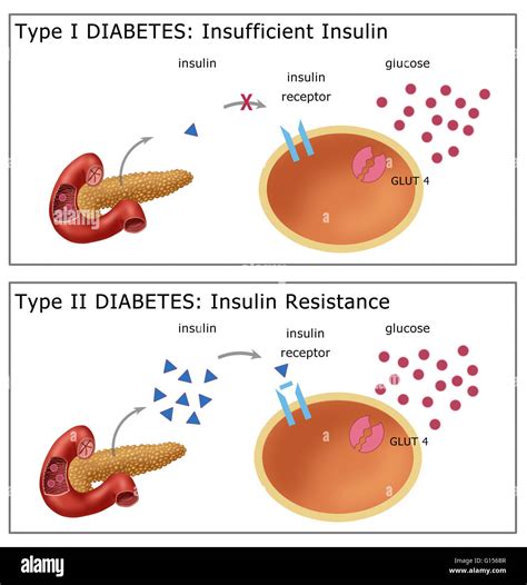type  diabetes diagram  res stock photography  images alamy