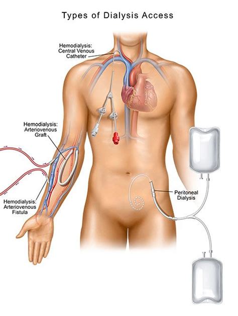 5 central venous catheter cvc complications