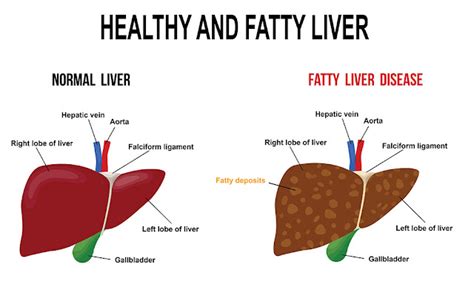 amudu what some one need to know about fatty liver