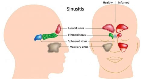 8 acupressure points for sinus treatment know how it scientifically