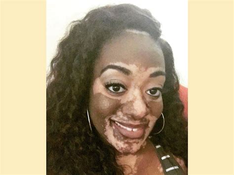 This Woman Developed Vitiligo Right Before Her Wedding Day
