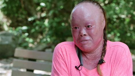 asian man with rare skin disease porn pic