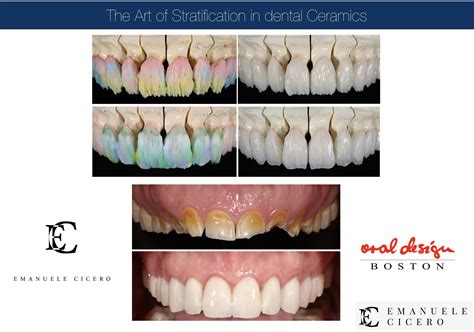 dental veneers advantages disadvantages duration emanuele