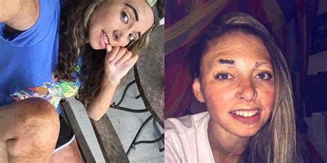 why this burn survivor is done covering up her scars self