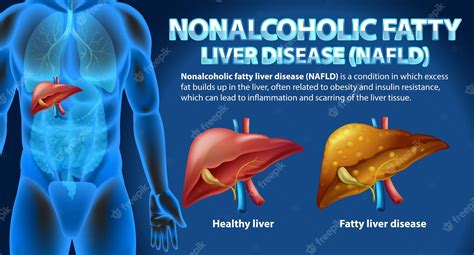 Free Vector Nonalcoholic Fatty Liver Disease Nafld