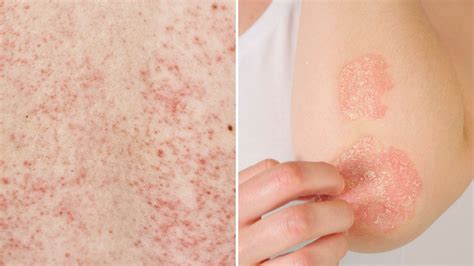Dermatitis Atópica ¿cómo Identificarla Y No Confundirla Con Un Problema