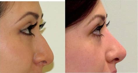 before and after non surgical rhinoplasty nosejob