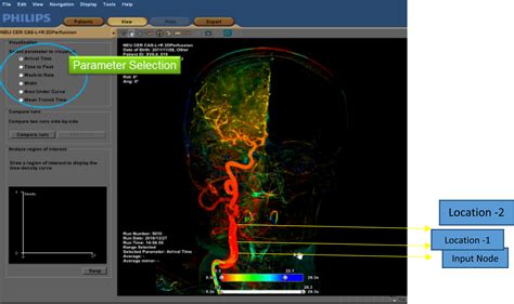 Computer Simulation Of Cerebral Arteriovenous Malformation—validation