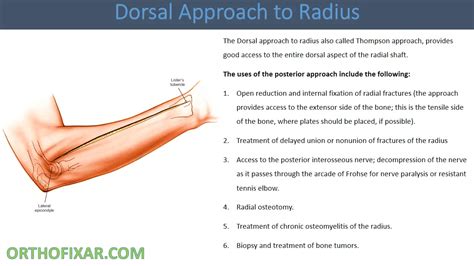 dorsal approach  radius easy tutorial orthofixar