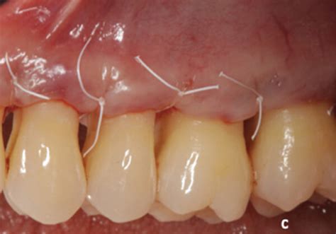 modified widman flap  performed  sites  suprabony periodontal