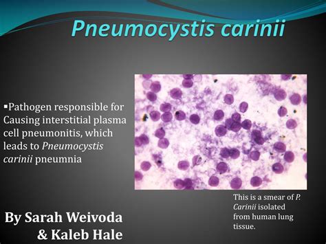 pneumocystis carinii powerpoint    id