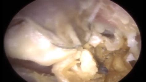 woman regains hearing after earwax extraction metro video