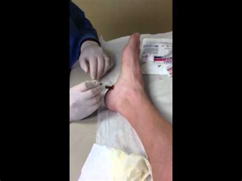 Cortisone injection for heel spur - YouTube