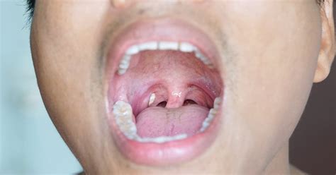 tonsil stones  bad breath smartmouth