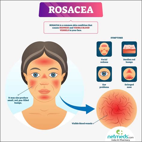 rosacea causes symptoms and treatment netmeds