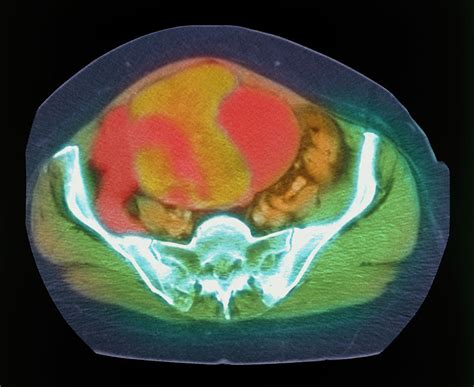 Coloured Mri Scan Of Ovarian Cancer Photograph By Science